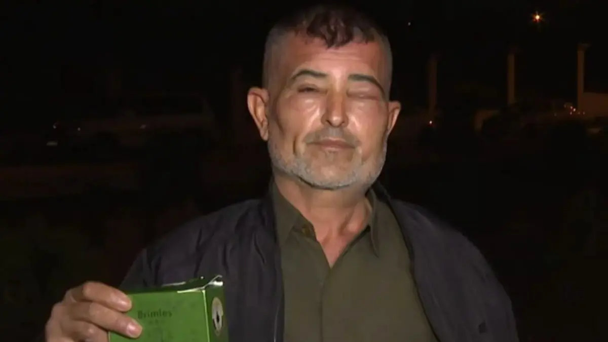 عراقي أصيب بـ"تشوهات" بسبب "شامبو" يكشف تفاصيل الواقعة