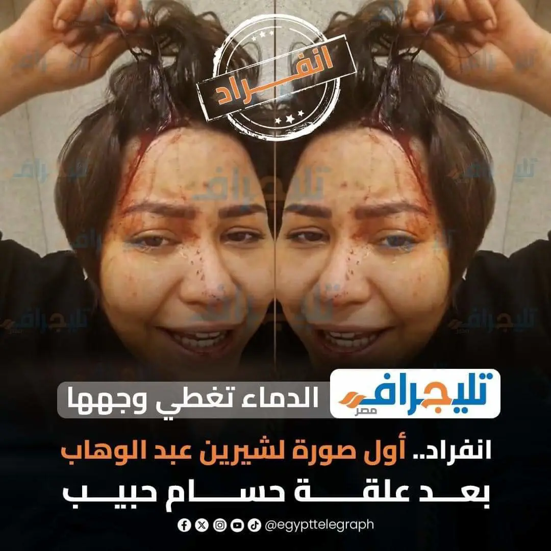 إصابة شيرين عبد الوهاب