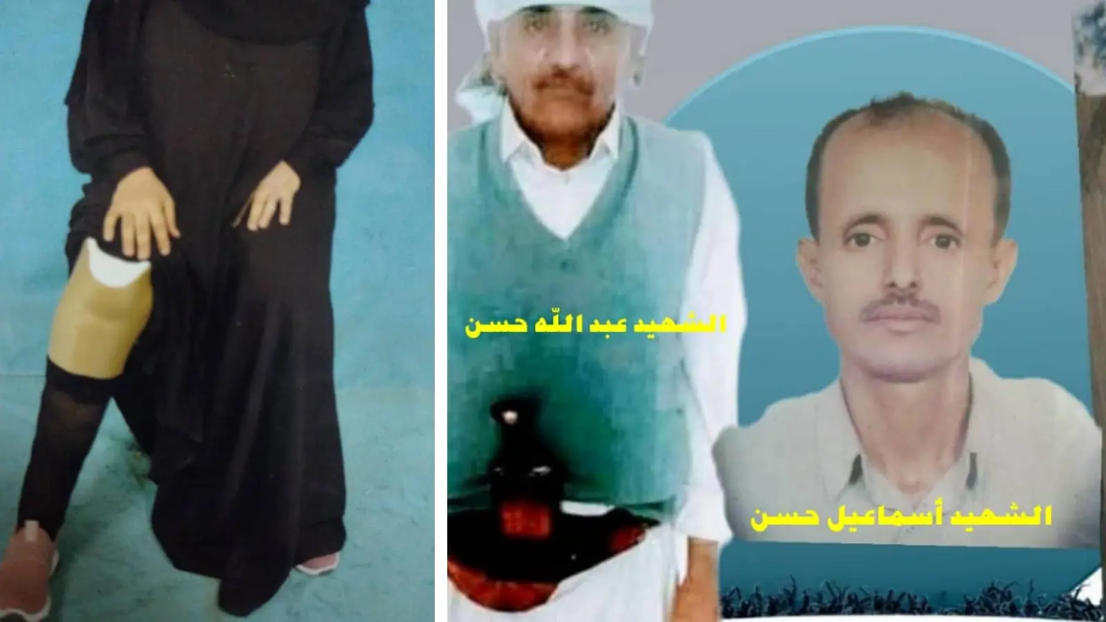شقيقا فادية المقتولين على يد قناص حوثي وتبدو قدم شقيقتها المبتورة
