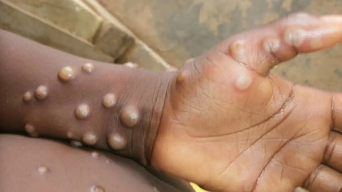 السودان يسجل أول إصابة بجدري القرود