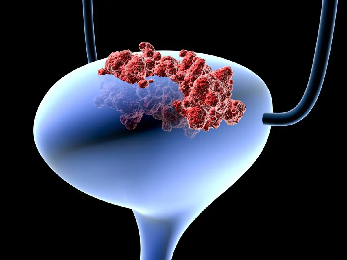 اكتشاف قد يحدث ثورة في علاج سرطان المثانة