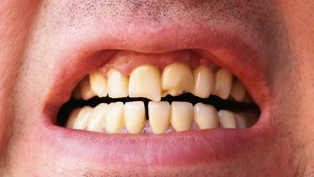7 عادات سيئة ضارة بالأسنان