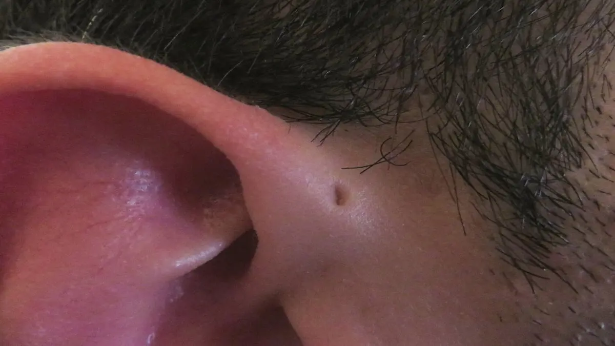 ابتكار تقنية جديدة قد تقود لعلاج تشوهات الأذن‎‎