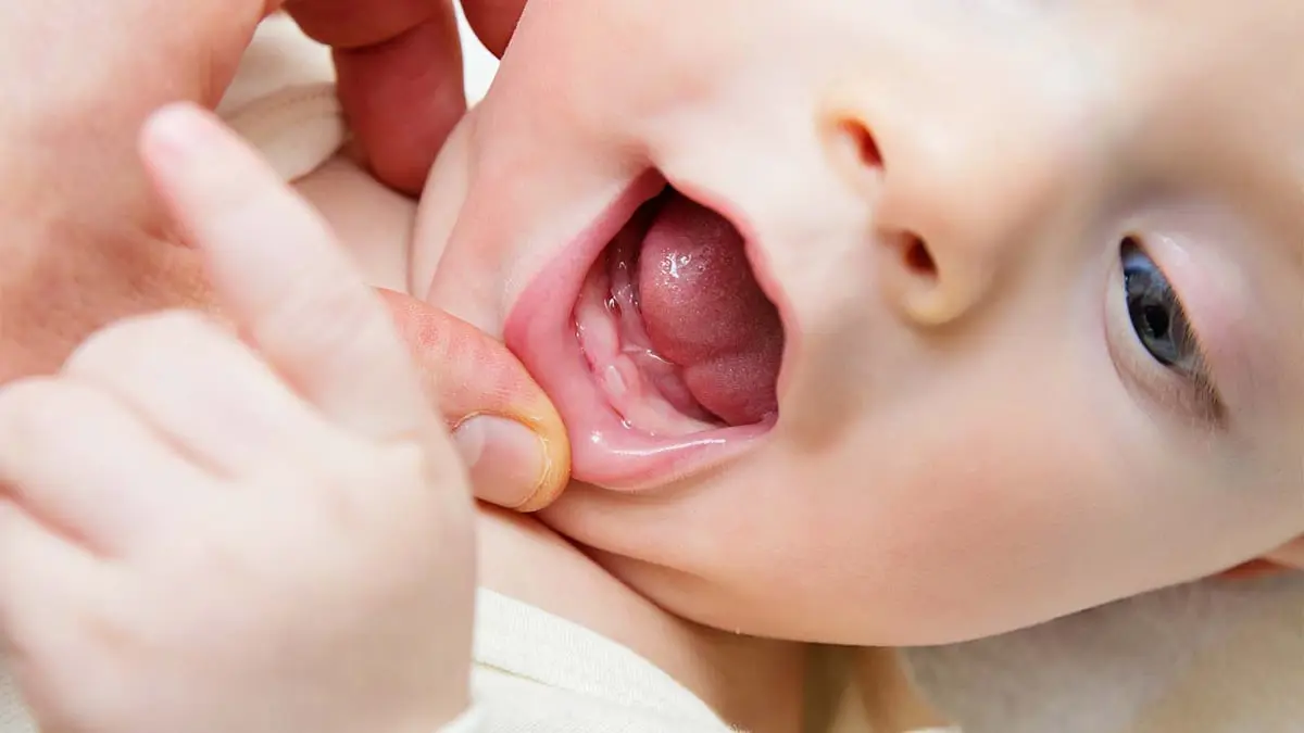 حبوب حمراء على اللسان عند الأطفال .. أسبابها وعلاجها 