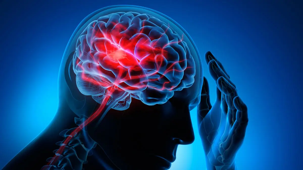 تقنية ذكاء اصطناعي تنقذ ضحايا السكتة الدماغية بنسبة 48%‎‎