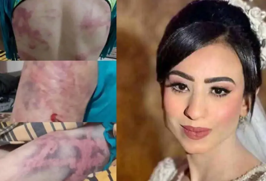 آثار العنف على جسد العروس مهرائيل صبري