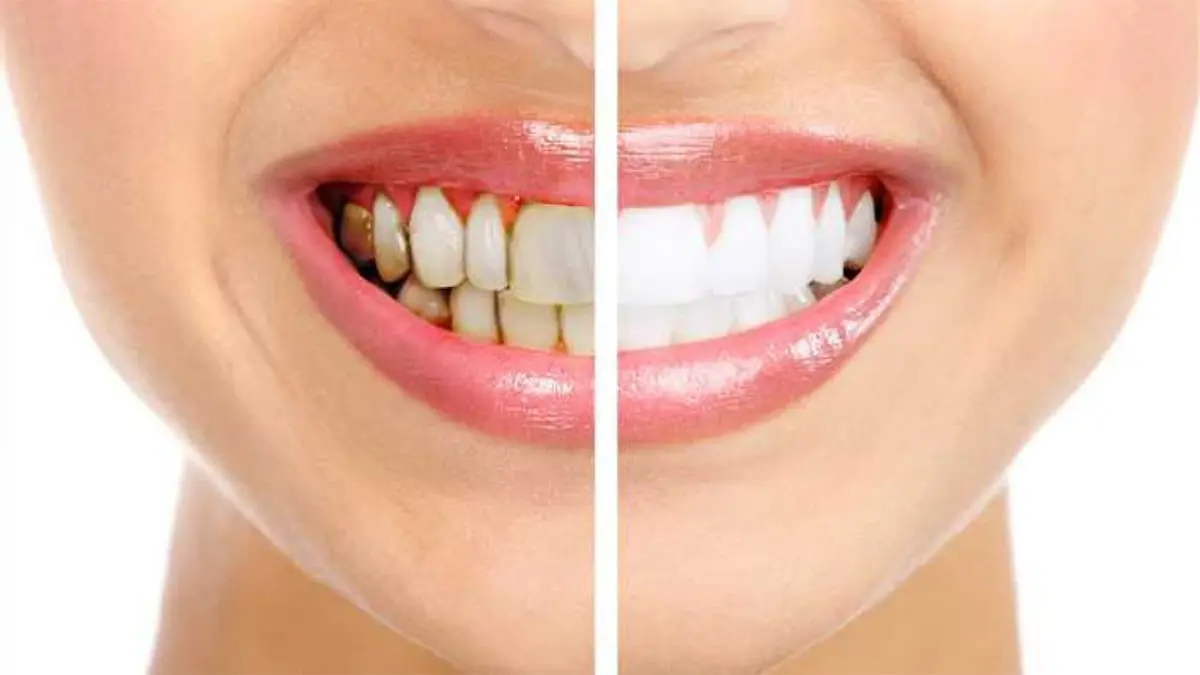دراسة.. إهمال تنظيف الأسنان قد يسبب الجلطات والخرف