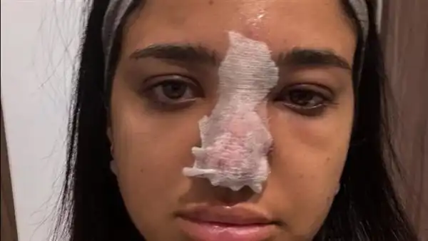 إصابة كنزي مدبولي بسبب حقنة فيلر