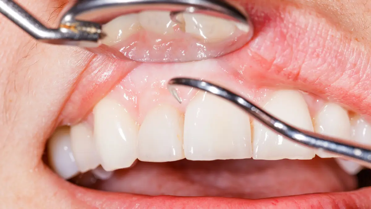 علاج لإعادة نمو الأسنان قد يكون متوفراً في 2030