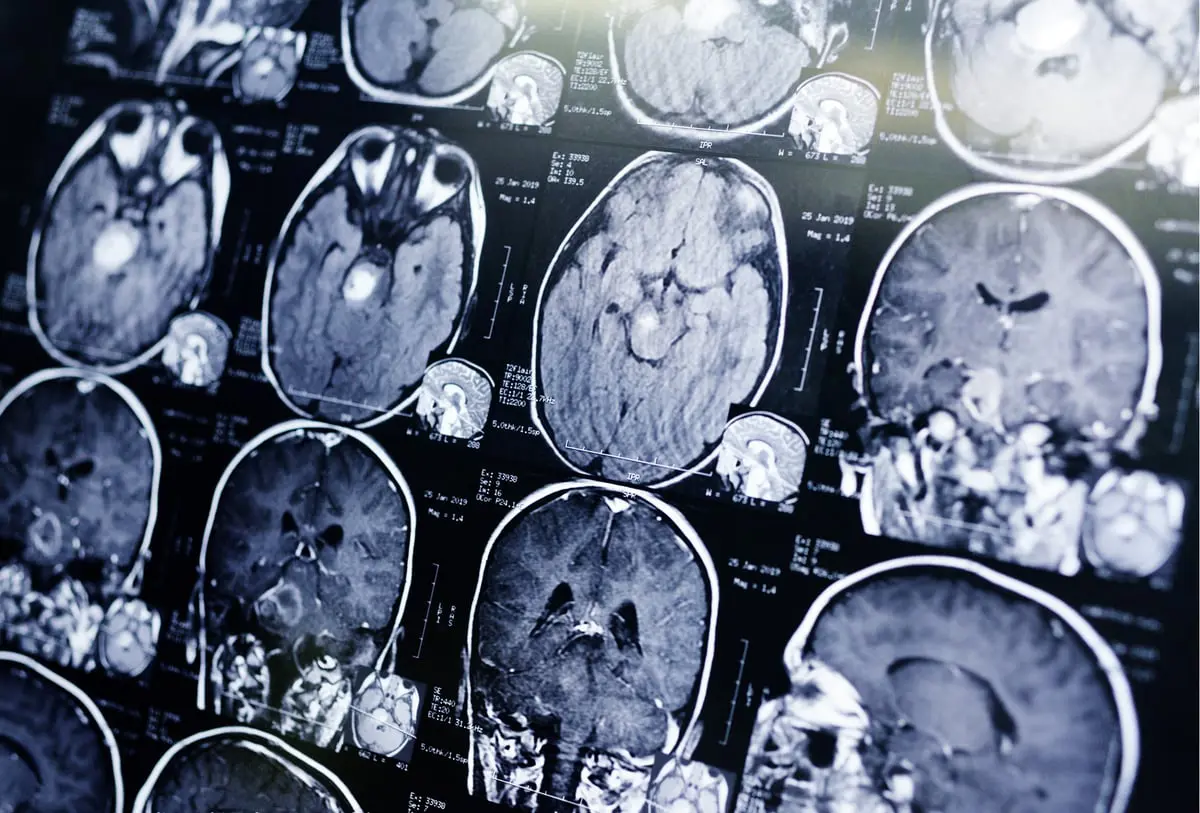 باحثون يحققون إنجازا في تشخيص أنواع من سرطان الدماغ 