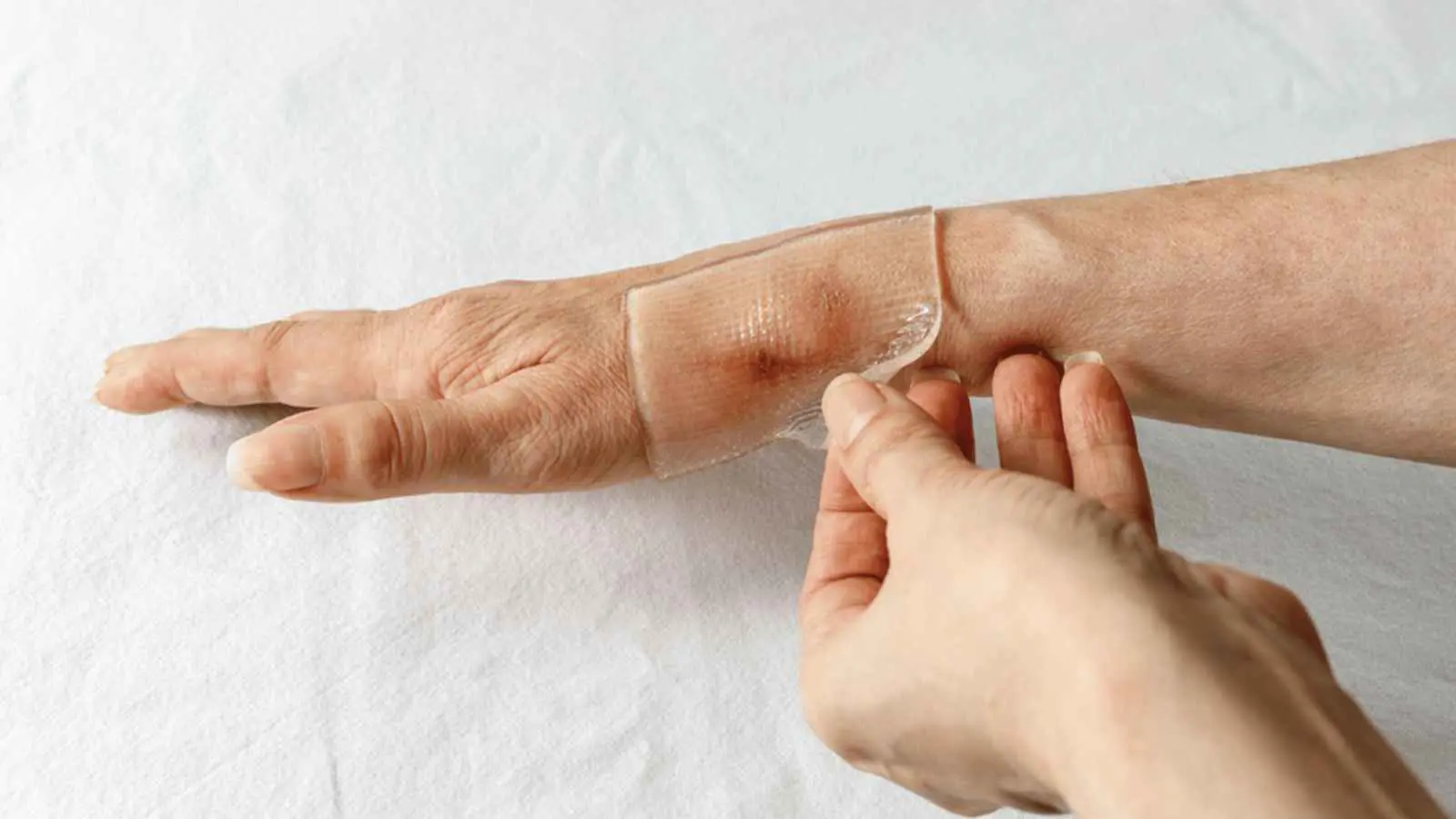 كيف تساعد شرائح السيليكون على علاج الندوب؟