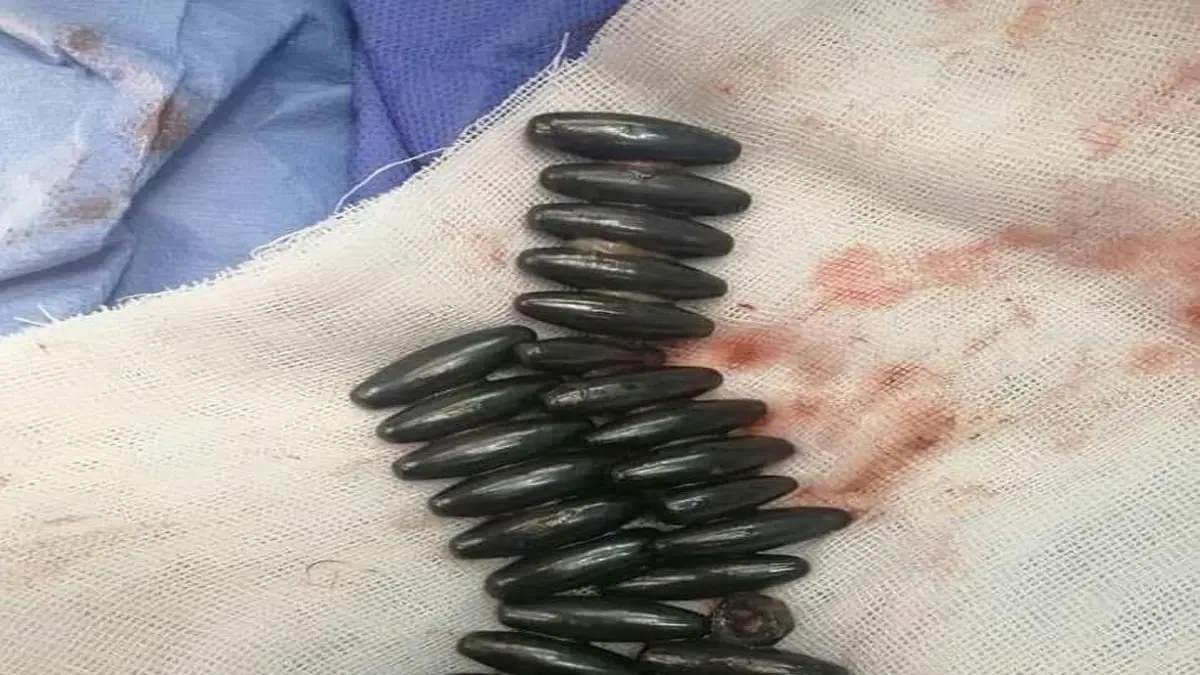 استخراج 30 قطعة معدنية من معدة طفلة مصرية (صورة)