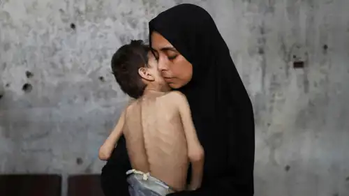  أم فلسطينية تحمل ابنها الذي يعاني من سوء التغذية