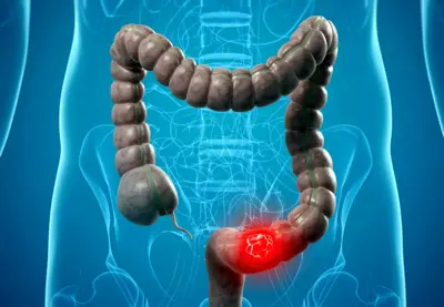 علامات لا ينبغي تجاهلها تحذرك من سرطان القولون والمستقيم