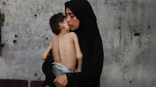 سيدة تحتضن طفلها الذي يعاني من سوء التغذية في غزة