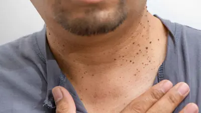 الزوائد الجلدية