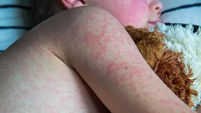 مرض الحصبة 